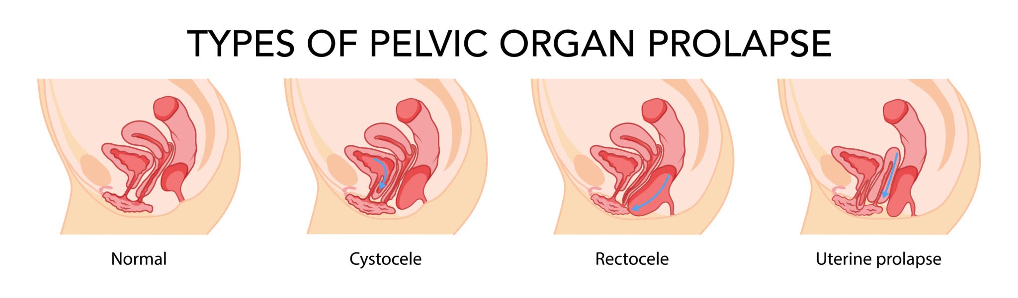 Medical diagram illustrating the four common types of pelvic organ prolapse: uterine prolapse, cervical prolapse, rectocele (rectum bulging into vagina), and cystocele (bladder bulging into vagina)